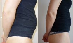 břicho před a po zákroku